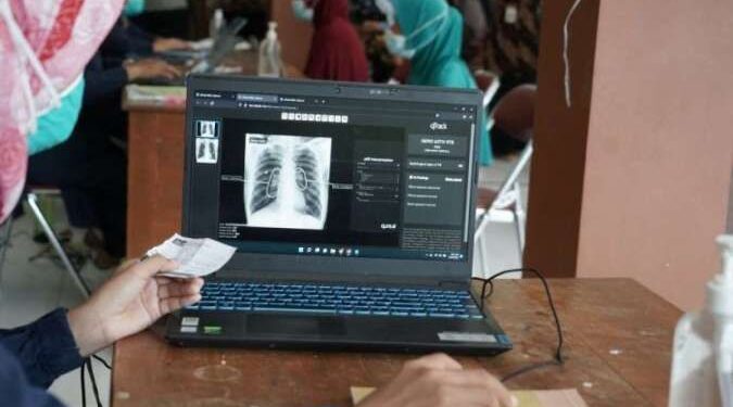 7 Pendekatan Kemenkes Deteksi Dini dan Perluas Layanan Tuberkulosis 1 Tuberkulosis