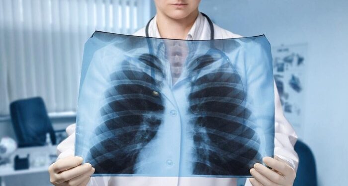 Kasus Pneumonia di Indonesia Meningkat Signifikan pada 2024 1 Pneumonia