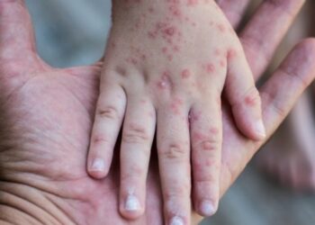 Kemenkes Laporkan Konten Hoaks Campak, Soroti Bahaya Provokasi Antivaksin