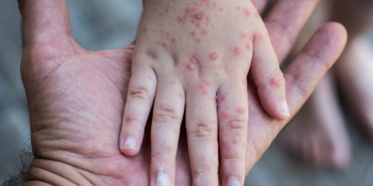 Kemenkes Laporkan Konten Hoaks Campak, Soroti Bahaya Provokasi Antivaksin