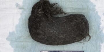 Remaja 16 Tahun Muntah, Dokter Temukan Gumpalan Rambut Seberat 1,5 Kg di Perut