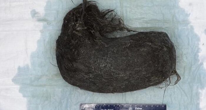 Remaja 16 Tahun Muntah, Dokter Temukan Gumpalan Rambut Seberat 1,5 Kg di Perut
